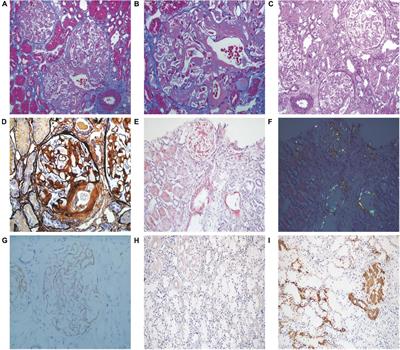 Idiopathic membranous nephropathy with renal amyloidosis: A case report